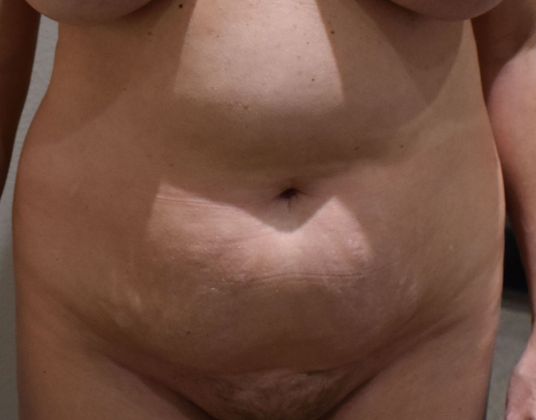Tummy Tuck (Abdominoplasty): Case 320 - Before