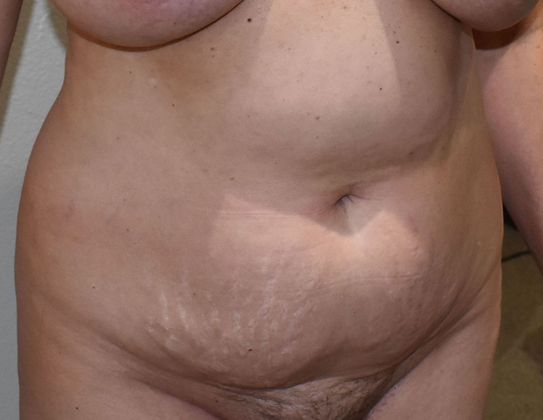 Tummy Tuck (Abdominoplasty): Case 320 - Before