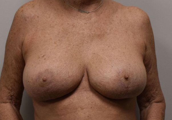 Breast Reduction Case 125 - After