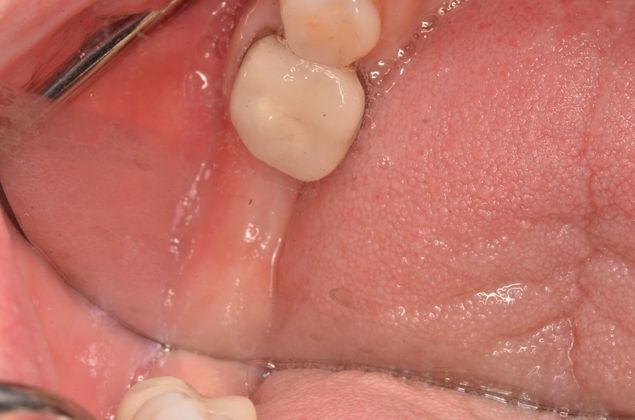 Dental Implants Case 53 - Before