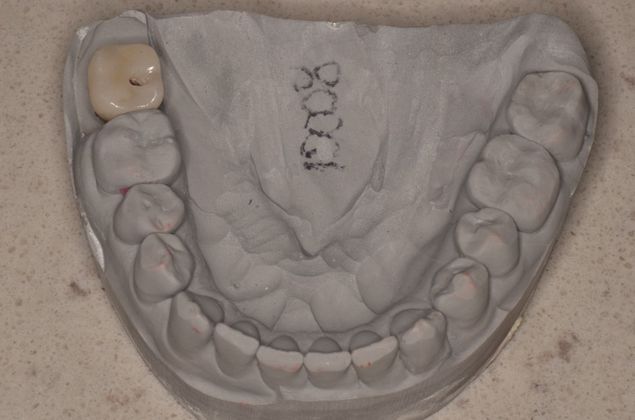 Dental Implants Case 53 - After
