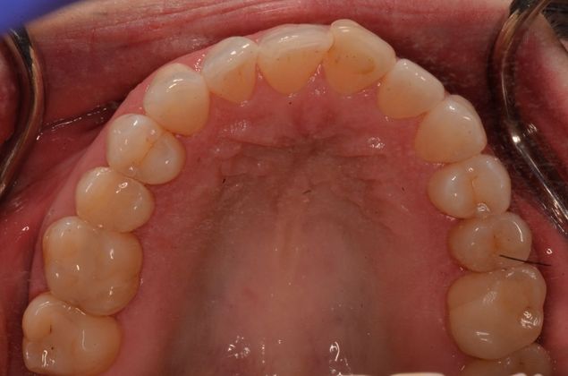Invisalign: Case 19 - Upper teeth before invisalign