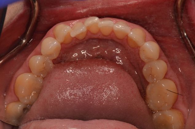 Invisalign: Case 19 - Lower teeth before invisalgin