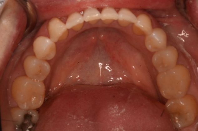 Invisalign: Case 19 - Lower teeth after invisalgin