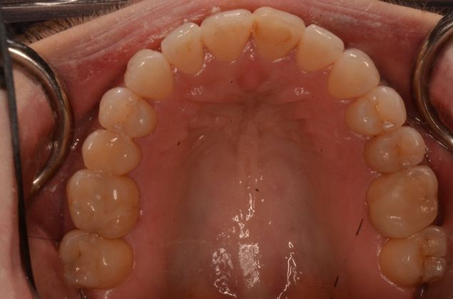 Invisalign: Case 19 - After invisalign (orthodontics)
