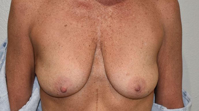 Breast Augmentation w/ Lift Case 398 - Before