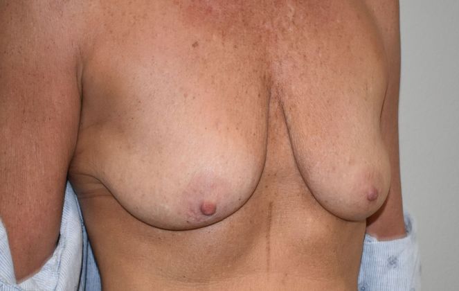 Breast Augmentation w/ Lift: Case 398 - Before