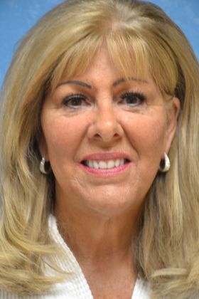 Face & Neck Lifts Case 1503- Sylvania, OH - After