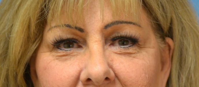 Eye Lift (Blepharoplasty) Case 1572- Sylvania, OH - Before