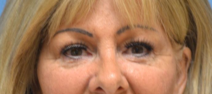Eye Lift (Blepharoplasty) Case 1572- Sylvania, OH - After
