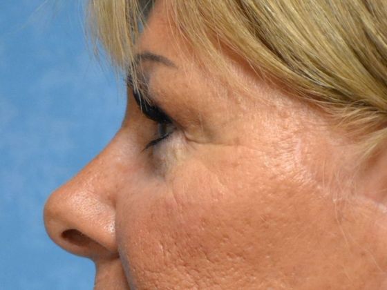 Eye Lift (Blepharoplasty): Case 1572- Sylvania, OH - After