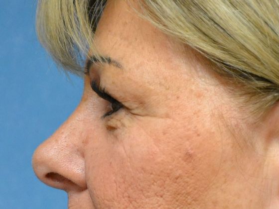 Eye Lift (Blepharoplasty): Case 1572- Sylvania, OH - Before