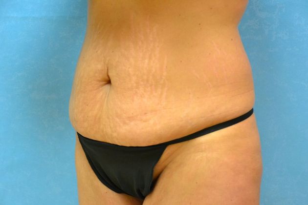 Tummy Tuck: Case 1800- Toledo, OH - Before