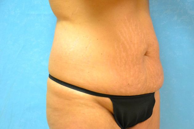Tummy Tuck: Case 1800- Toledo, OH - Before