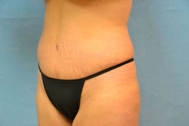 Tummy Tuck: Case 1800- Toledo, OH - After