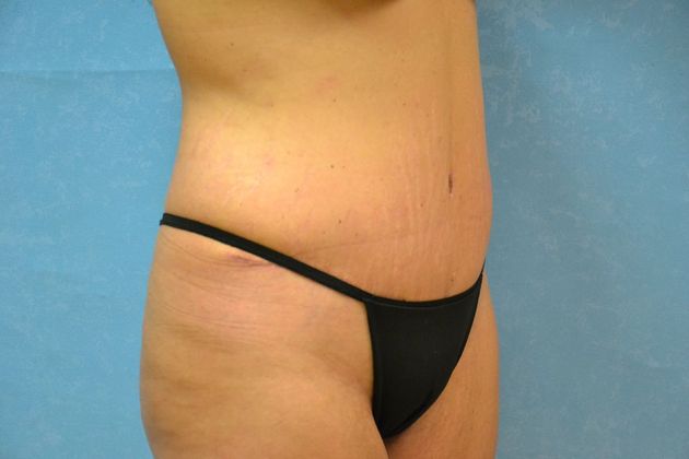 Tummy Tuck: Case 1800- Toledo, OH - After