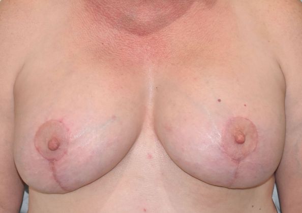 Breast Augmentation w/ Lift Case 399 - After