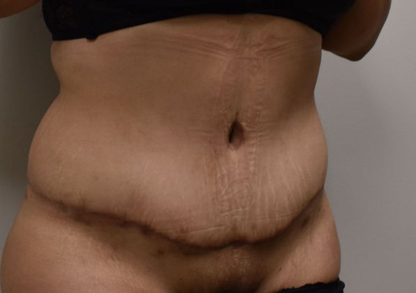 Tummy Tuck (Abdominoplasty): Case 322 - After