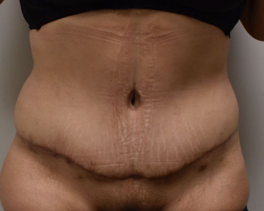 Tummy Tuck (Abdominoplasty): Case 322 - After