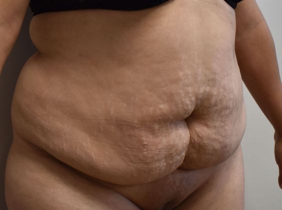 Tummy Tuck (Abdominoplasty): Case 322 - Before