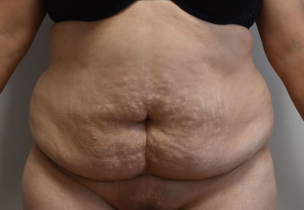 Tummy Tuck (Abdominoplasty): Case 322 - Before