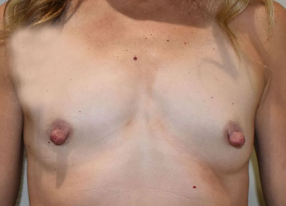 Breast Augmentation Case 670 - Before