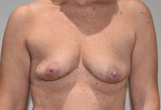 Breast Augmentation Case 671 - Before