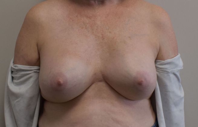 Breast Revision: Case 177 - Before