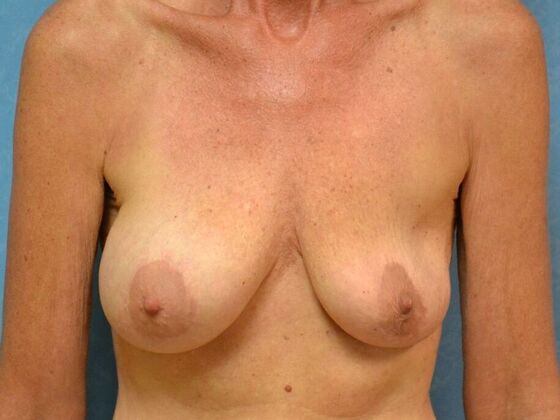 Breast Augmentation Case 1370- Lima, OH - Before