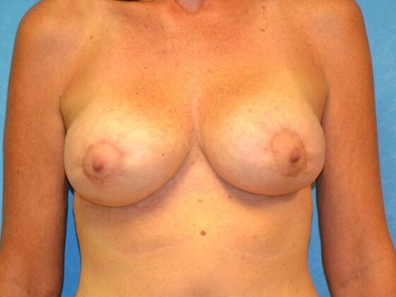 Breast Augmentation Case 1370- Lima, OH - After