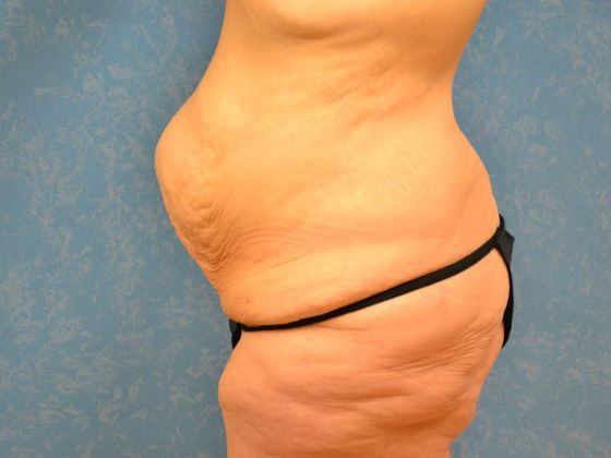 Bodylift: Case 1527- Toledo, OH - Before