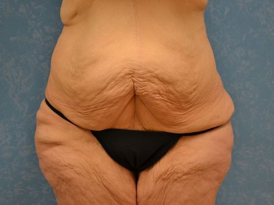 Bodylift Case 1527- Toledo, OH - Before