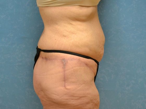 Bodylift: Case 1527- Toledo, OH - After