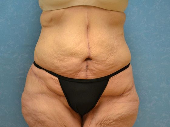 Bodylift Case 1527- Toledo, OH - After