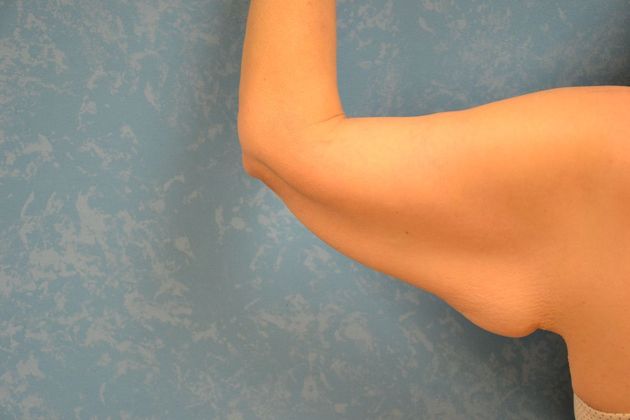 Arm Lift Case 1430- Toldeo, OH - Before