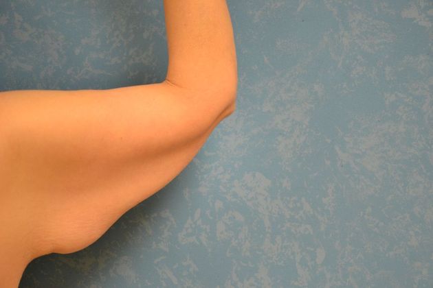 Arm Lift: Case 1430- Toldeo, OH - Before