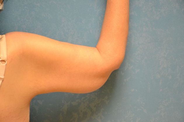 Arm Lift: Case 1430- Toldeo, OH - After