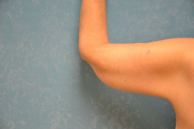 Arm Lift Case 1430- Toldeo, OH - After