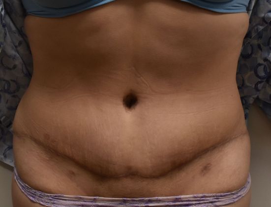 Tummy Tuck (Abdominoplasty): Case 323 - After