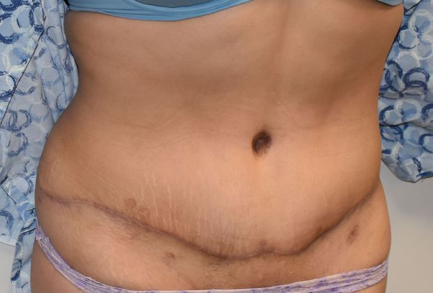 Tummy Tuck (Abdominoplasty): Case 323 - After
