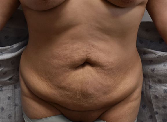 Tummy Tuck (Abdominoplasty): Case 323 - Before