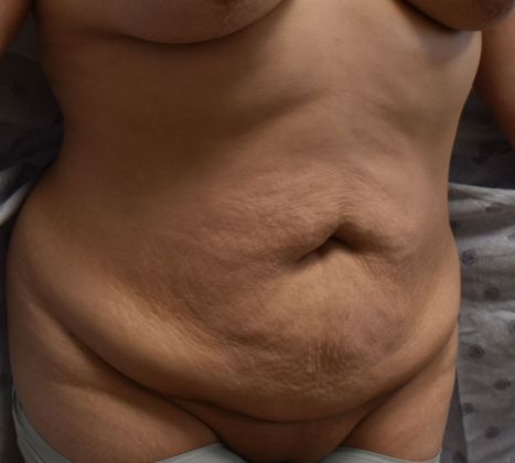 Tummy Tuck (Abdominoplasty): Case 323 - Before