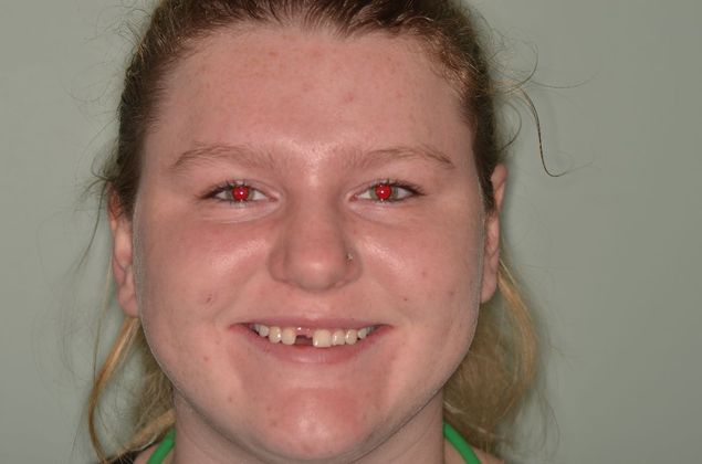 Dental Implants Case 54 - Before