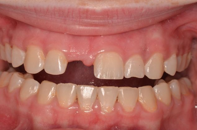 Dental Implants: Case 54 - Before implant but after tooth was extracted