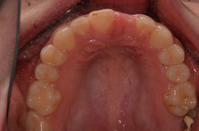 Dental Implants: Case 54 - Before implant but after tooth was extracted