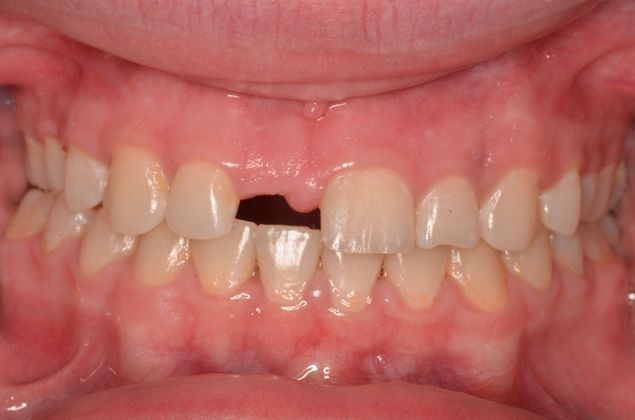Dental Implants: Case 54 - Before implant crown