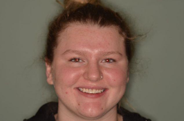 Dental Implants Case 54 - After