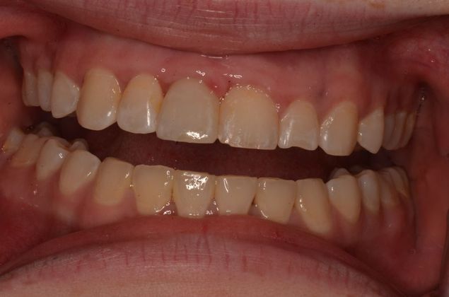 Dental Implants: Case 54 - After implant and crown
