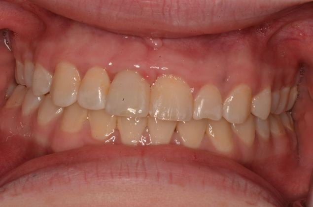 Dental Implants: Case 54 - After implant and implant crown