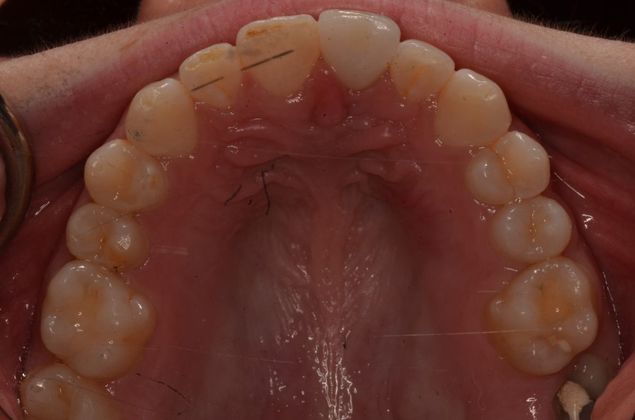 Dental Implants: Case 54 - After implant placement